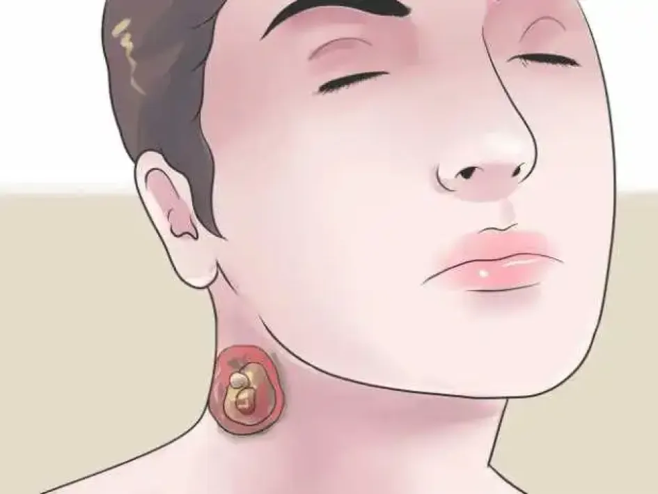 como-quitarse-un-nacido-header Ilustración de un hombre con un nacido en el cuello