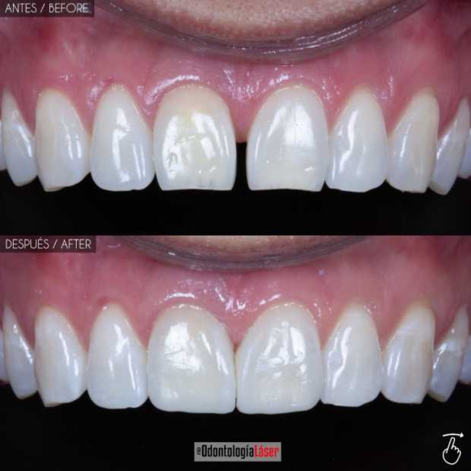 ¿El diseño de sonrisa daña tus dientes? ¿El diseño de sonrisa daña tus dientes?