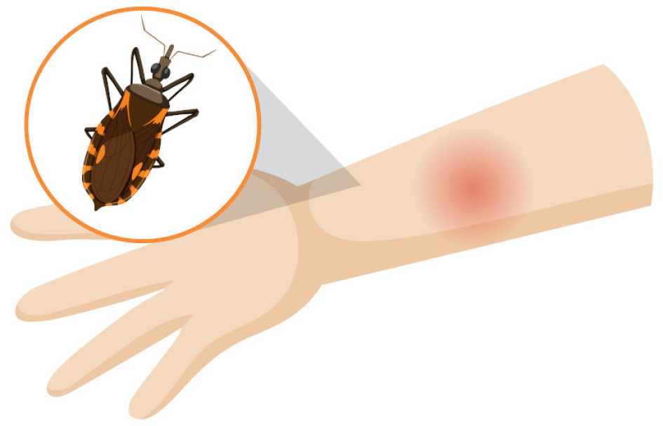 Salud Enfermedad de Chagas