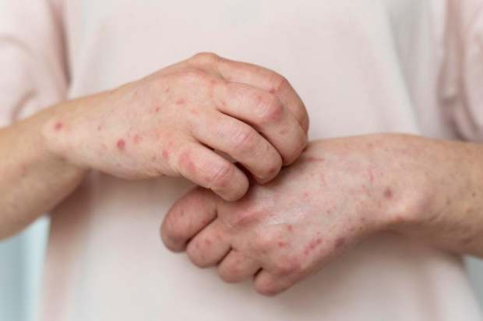 La Dirección Territorial de Salud de Caldas indica que los siguientes son síntomas de brotes de enfermedades virales eruptivas como varicela y síndrome de mano-pie-boca: brotes en la piel (ampolla, ronchas, lesiones), fiebre, desaliento, falta de apetito. La Dirección Territorial de Salud de Caldas indica que los siguientes son síntomas de brotes de enfermedades virales eruptivas como varicela y síndrome de mano-pie-boca: brotes en la piel (ampolla, ronchas, lesiones), fiebre, desaliento, falta de apetito.