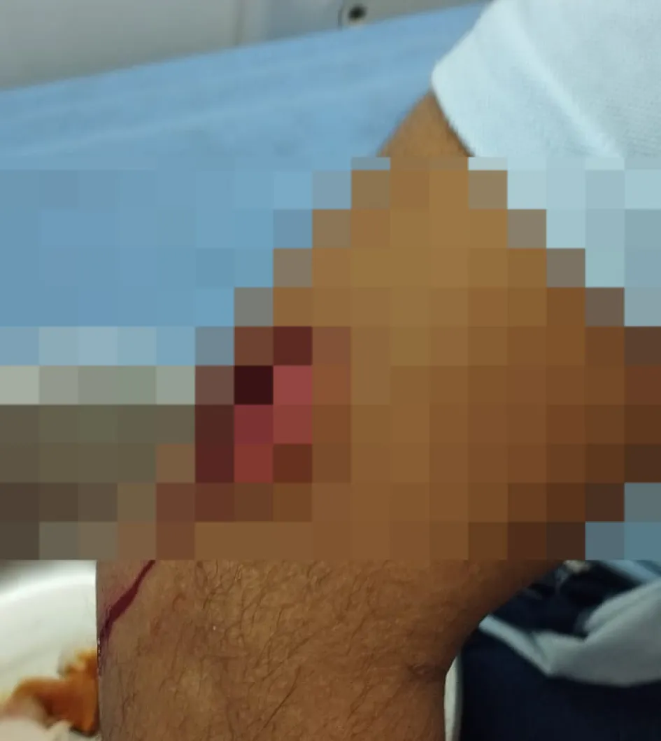 En el antebrazo derecho fue herido con arma blanca el dragoneante del Inpec. En el antebrazo derecho fue herido con arma blanca el dragoneante del Inpec.