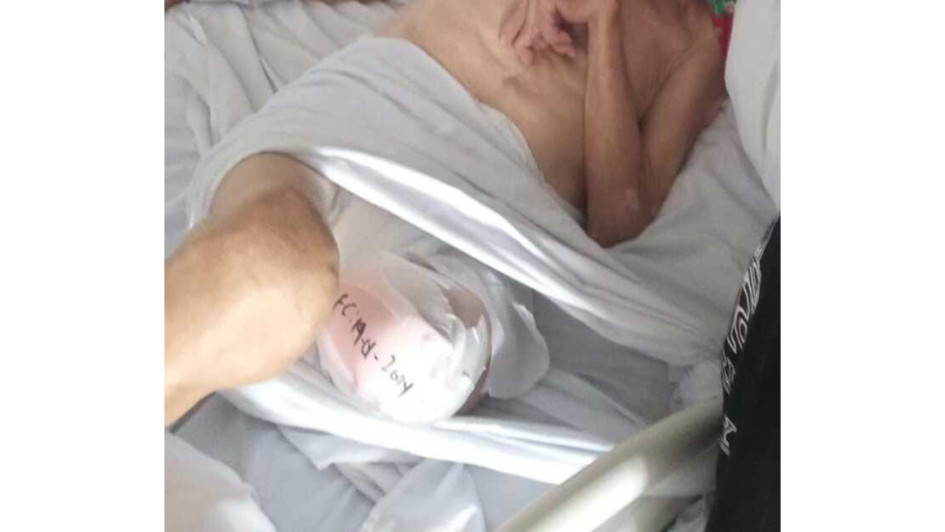 Esta es una imagen de Gildardo Aguirre Suárez, de 91 años, facilitada por sus familiares. La foto se tomó tras la amputación de su miembro inferior izquierdo. Esta es una imagen de Gildardo Aguirre Suárez, de 91 años, facilitada por sus familiares. La foto se tomó tras la amputación de su miembro inferior izquierdo.