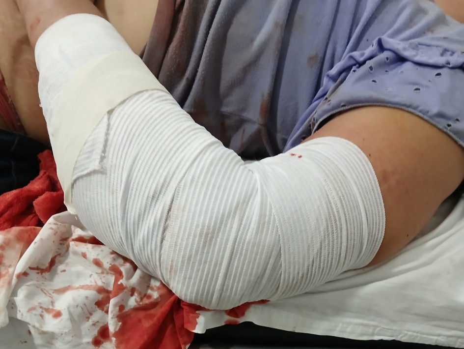 La mujer sufrió una lesión en un brazo, lo que requirió de atención de urgencias y traslado a un hospital en La Dorada. La mujer sufrió una lesión en un brazo, lo que requirió de atención de urgencias y traslado a un hospital en La Dorada.