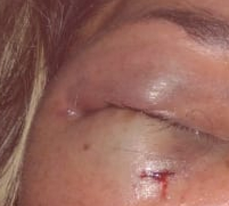 Foto | Suministrada | LA PATRIA La mujer agredida por un actor manizaleño. "Te voy a matar, te voy a matar", me decía. La dama tuvo que atravesar la nevera para evitar que él se le acercara más. Ella tuvo equimosis y cerramiento ocular. Foto suministrada| LA PATRIA La mujer agredida por un actor manizaleño. "Te voy a matar, te voy a matar", me decía. La dama tuvo que atravesar la nevera para evitar que él se le acercara más. Ella tuvo equimosis y cerramiento ocular.