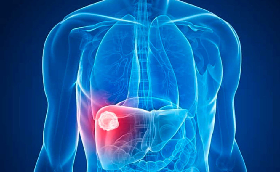 Un nivel alto de triglicéridos puede tender a causar enfermedades como hígado graso (foto) o pancreatitis (inflamación del páncreas). Un nivel alto de triglicéridos puede tender a causar enfermedades como hígado graso (foto) o pancreatitis (inflamación del páncreas).